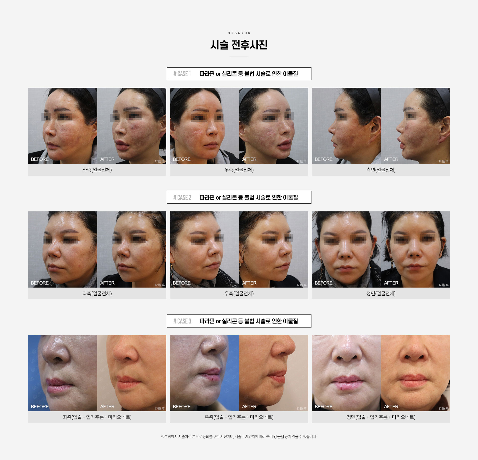 비수술 이물질제거, 야녹주사 전후사진